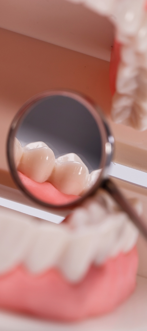 Removable Restoration