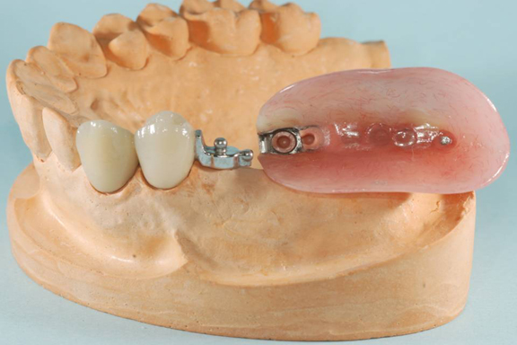 Dental attachment